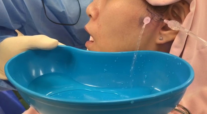 一名門診病人在局部麻醉的情況下，進行顳下頜關節沖洗治療。