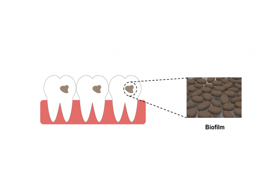 Biofilm formed by bacteria and fungi attaching to tooth surfaces 