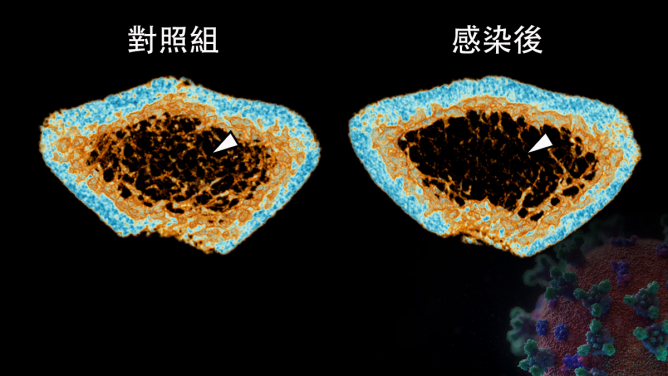 嚴重急性呼吸綜合症冠狀病毒2（SARS-CoV-2) 感染可導致新冠肺炎患者在急性期及康復後期出現炎性骨質流失。三維微米級計算機斷層成像技術重建顯示，感染新冠病毒的倉鼠（圖右）在股骨的小梁骨（白色箭頭）密度明顯低於未感染病毒的對照組（圖左）。
 