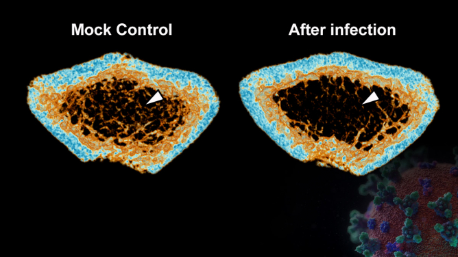 嚴重急性呼吸綜合症冠狀病毒2（SARS-CoV-2) 感染可導致新冠肺炎患者在急性期及康復後期出現炎性骨質流失。三維微米級計算機斷層成像技術重建顯示，感染新冠病毒的倉鼠（圖右）在股骨的小梁骨（白色箭頭）密度明顯低於未感染病毒的對照組（圖左）。
 